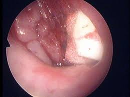 腺样体肥大的发病原因