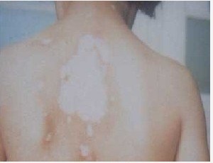 腰上白癜风的病因有哪些 儿童白癜风的发病因素