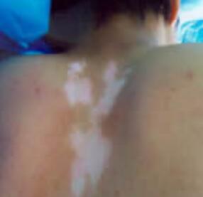 小儿白斑如何去调养 白斑治疗方法有哪些